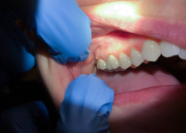 Best Urgent Care for Lost Fillings or Crowns in South Apopka, FL